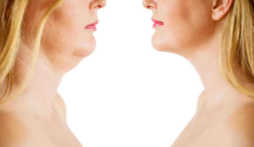 Double Chin treatment Godmanchester before and after results