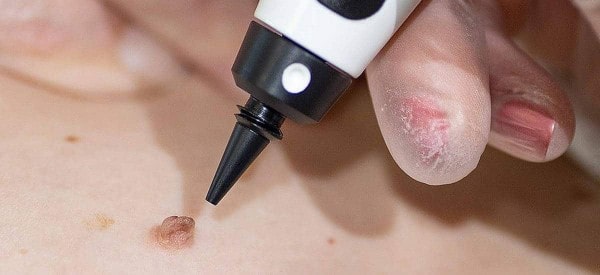 After Skin Tag Removal Godmanchester