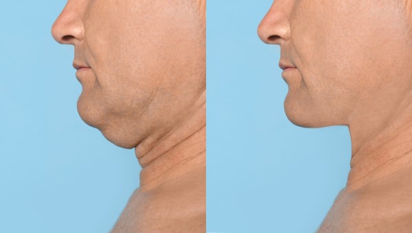 Which Non-Surgical Treatments Work Best for Jowls and Loose Skin Godmanchester?