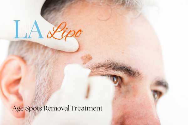 What Are the Most Effective Treatments for Age Spots Godmanchester?