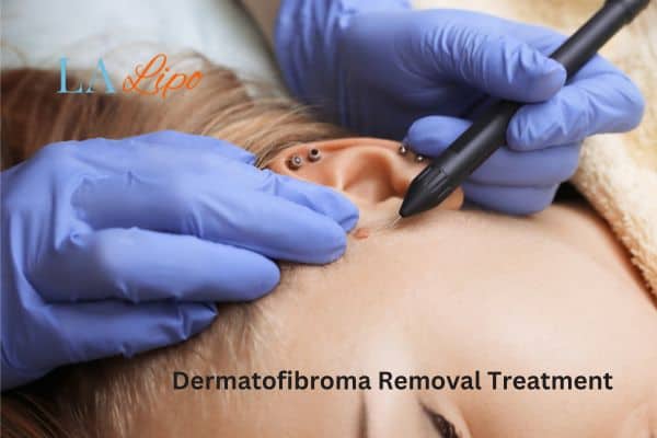 Dermatofibroma Removal Treatment Godmanchester