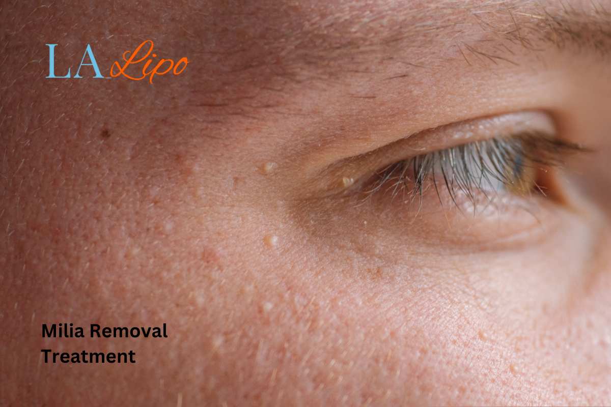 Cryopen Milia Removal: Is It the Easiest and Safest Option Godmanchester?