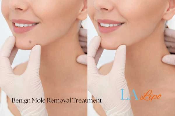 Before-and-after results following benign mole-removal treatment Godmanchester