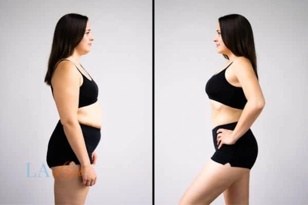 image of woman before and after results of LA-EMS Body Sculpting Godmanchester to help treat Diastasis recti