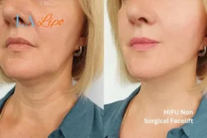 hi-fu for wrinkles Godmanchester before and after results