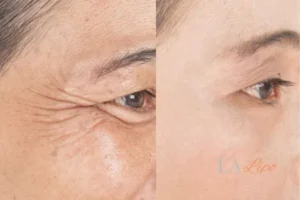 Before and after results of woman - HI-fu wrinkles reduction treatment Godmanchester