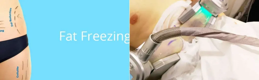 Fat freezing Godmanchester on multiple areas of the body