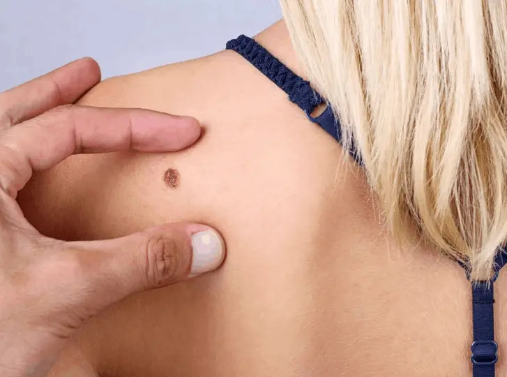 woman having mole removal Godmanchester consultation before treatment.