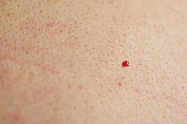 close up of a cherry angioma Godmanchester