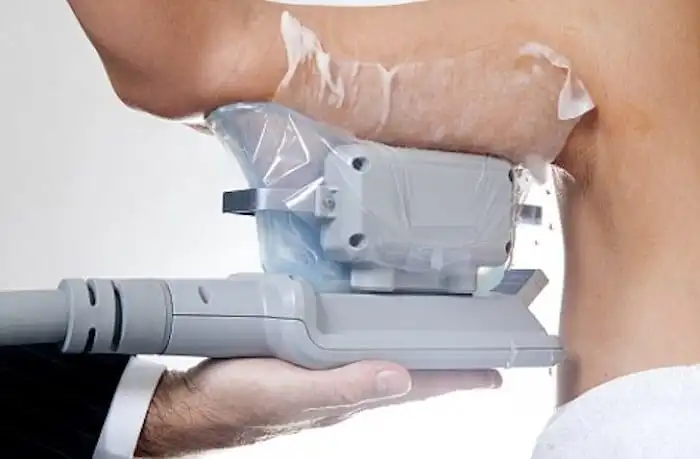 Picture of fat freezing Godmanchester on the upper arms.