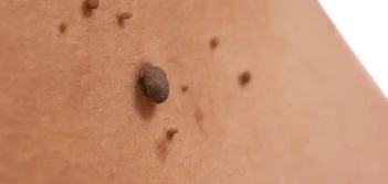 image of a skin tag Godmanchester