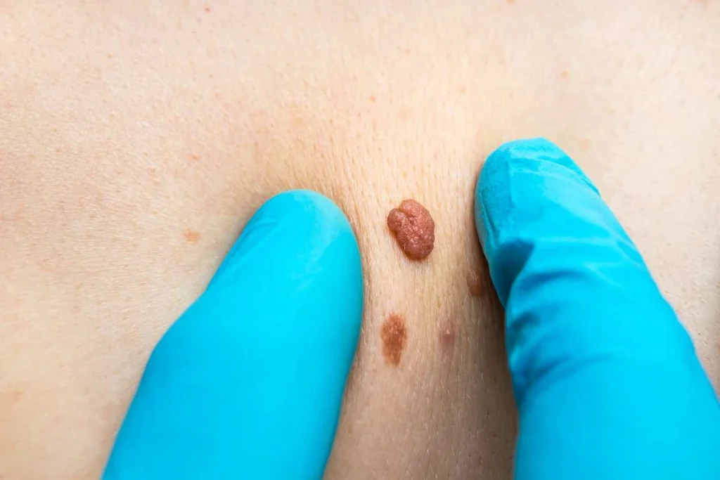 Consultant examining a skin tag Godmanchester