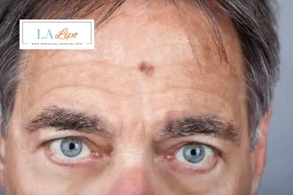 Solar Lentigo Removal Godmanchester image of man with mark on his forehead