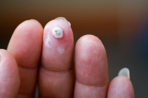 wart on person finger - cryotherapy to treat from LA LIPO Godmanchester