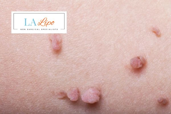 Does cryopen skin tag removal Godmanchester hurt? Find out now call our team today!