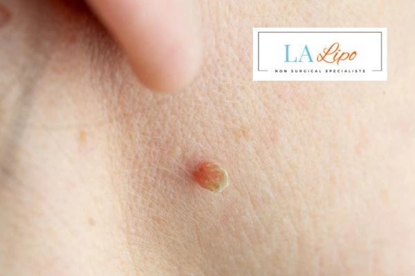 Book skin tag removal Godmanchester today speak to our team now!