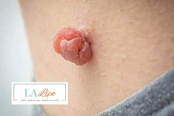 Interested in skin tag removal Godmanchester? Concerned about the pain? Find out more today!