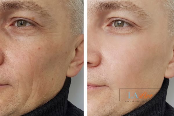 See the amazing results of Morpheus8 Treatment Godmanchester!