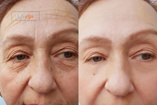 The powerful benefits of Morpheus8 Treatment Godmanchester - Call Our team today!