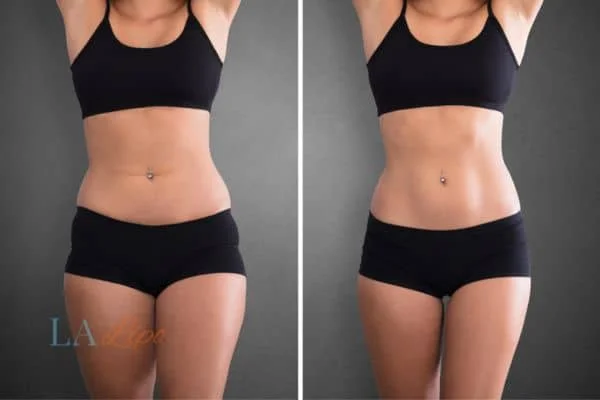 before and after results of non-surgical treatment to help a woman's body image and mental health Godmanchester