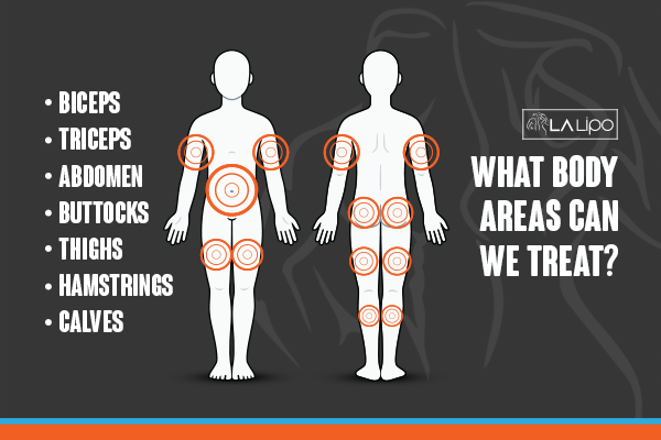 Diagram to show areas you can have LA-EMS Body Sculpting Treatment Godmanchester