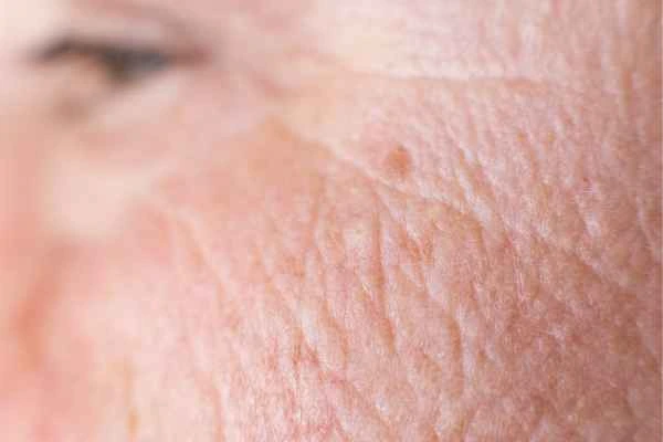 close up picture of a woman's face showing an age spot Godmanchester