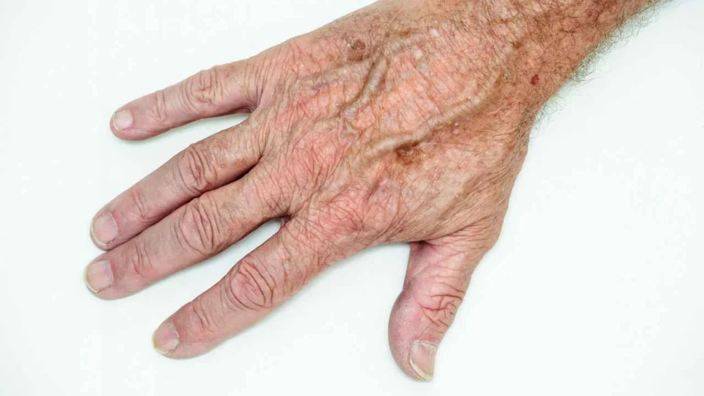 Male hand showing age spot Godmanchester
