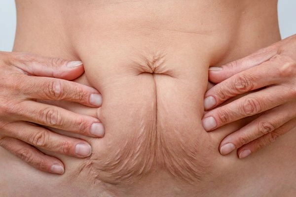 Should I Combine Diastasis Recti Treatment with Body Contouring for Better Results Godmanchester?